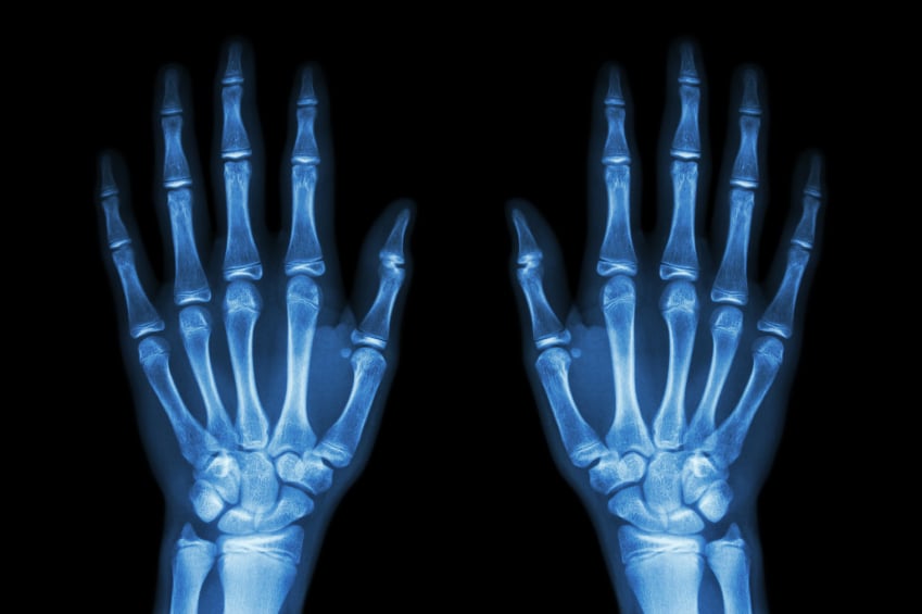 X-ray hands