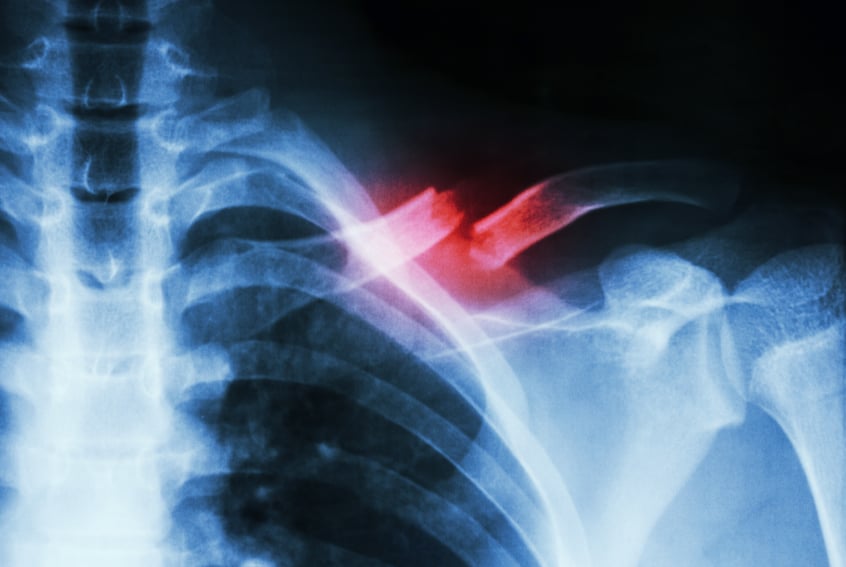 x-ray of a broken collarbone