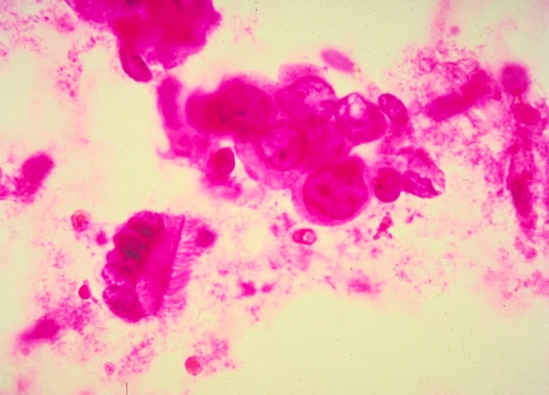 Cancerous cells Cancerous cells