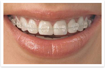 ceramic braces, oral b