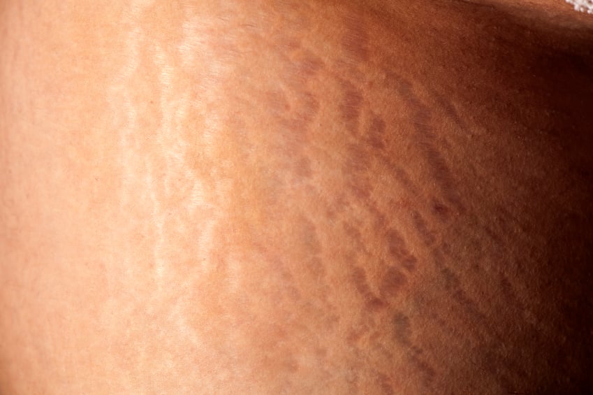 Stretch marks across skin