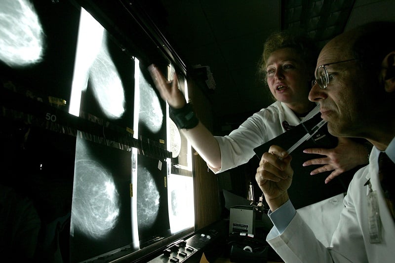 Doctors look at films of breast x-rays at the UCSF Comprehensive Cancer Center
