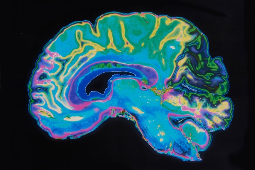 MRI Image for Brain
