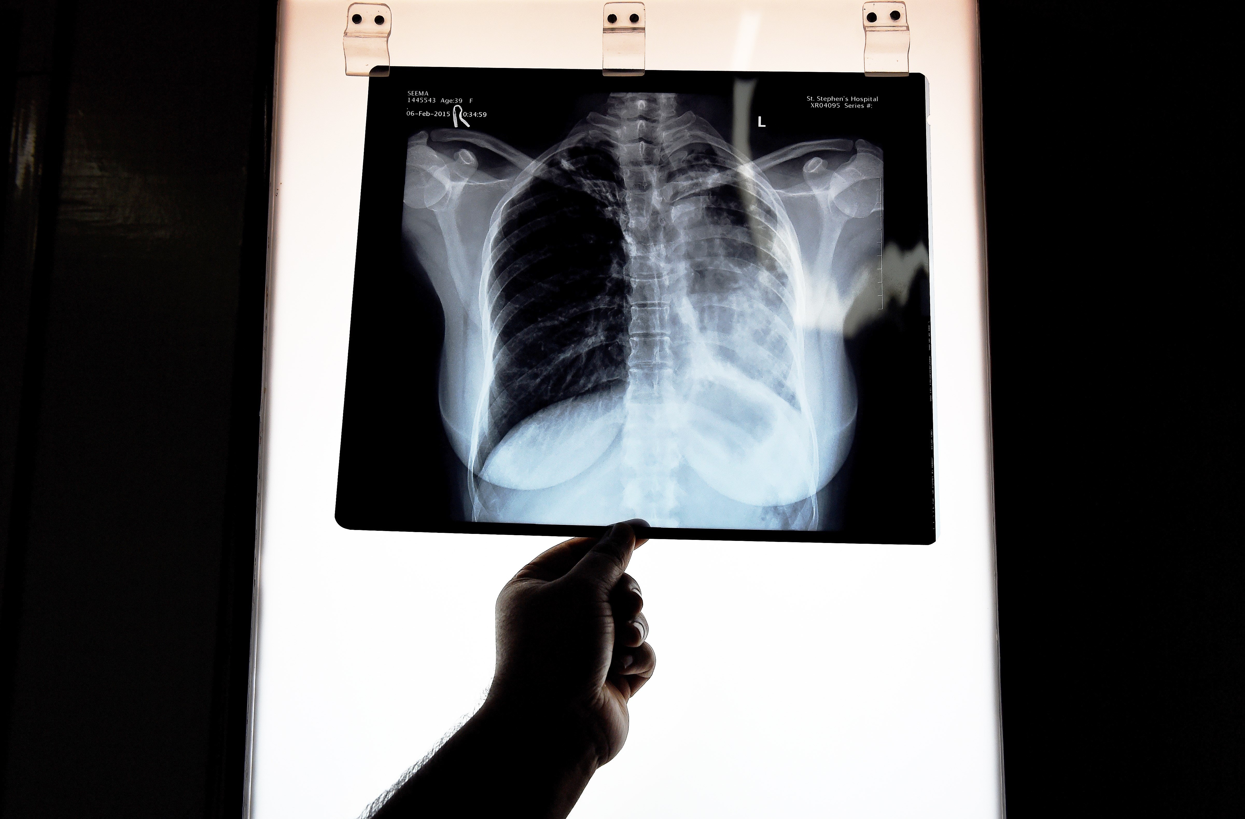 Doctors examine x-rays from asthma patients, who are frequently being given a misdiagnosis