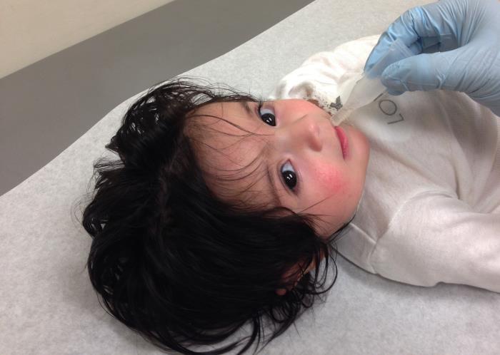 A child infected with Haemophilus influenzae. A child infected with Haemophilus influenzae.