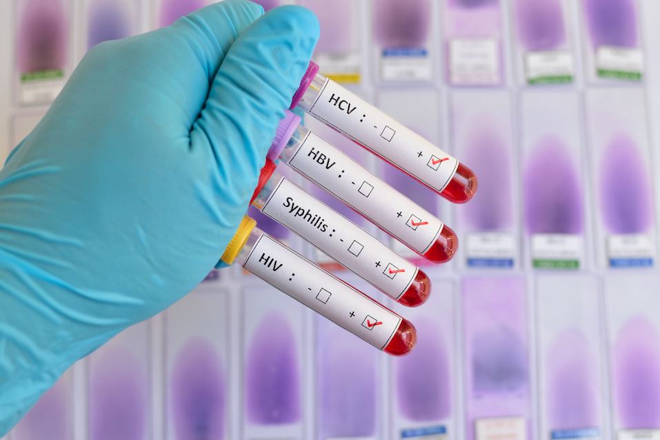 Blood sample positive with sexually transmitted diseases: HIV, HBV, HCV, Syphilis