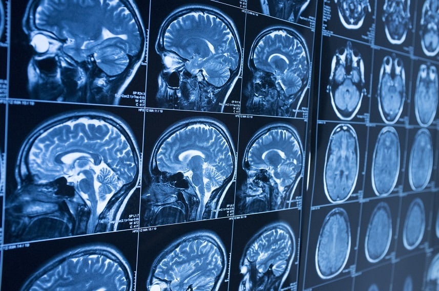 MRI brain scan images MRI brain scan images