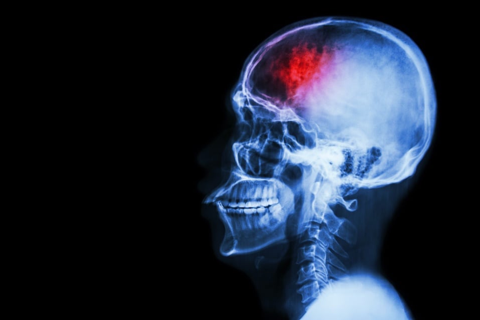 Film x-ray showing a skull with a stroke