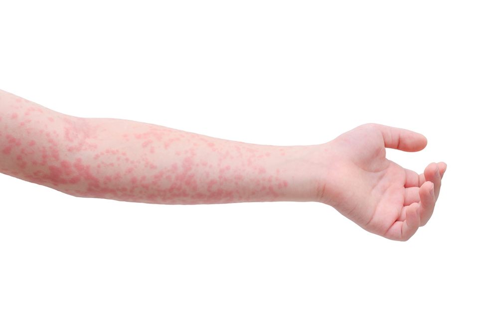 You'll think twice about hopping into the hot tub after you read about folliculitis.