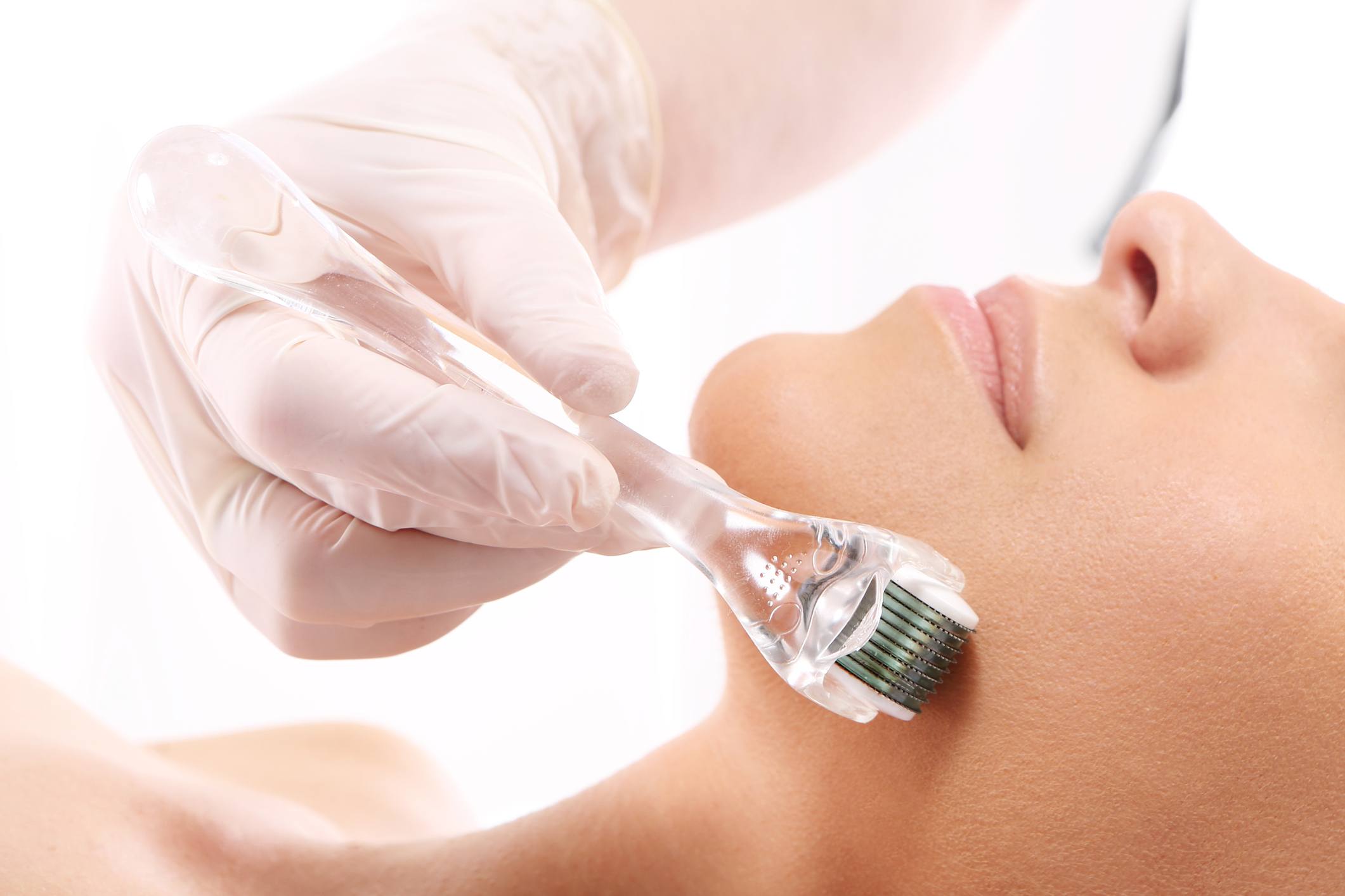 Micro-needling or Derma-rolling