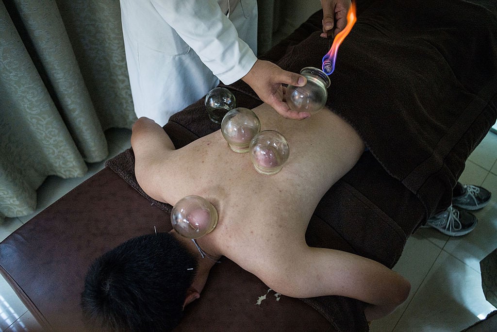 Undergoing Traditional Cupping Treatment In Hong Kong