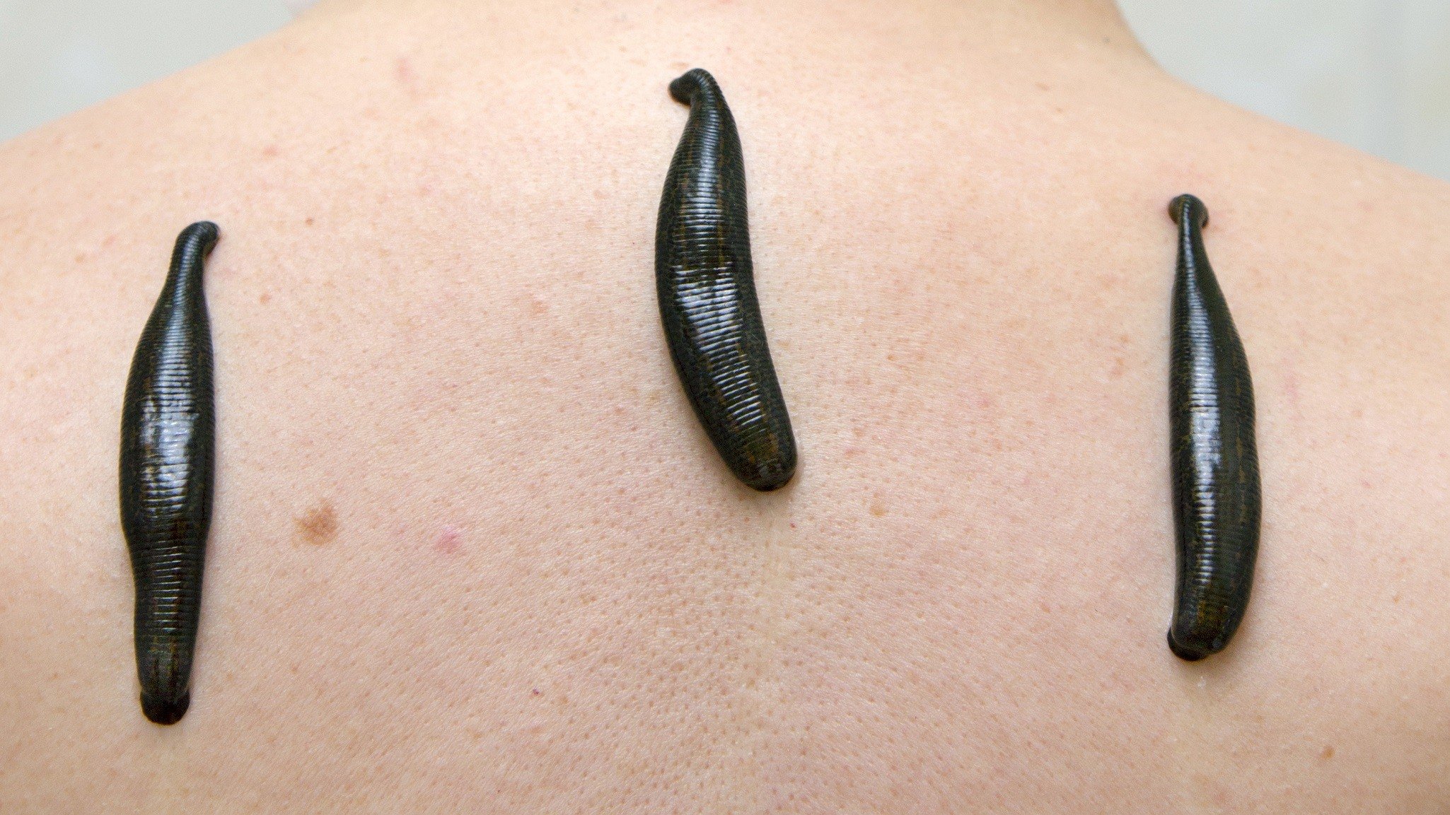 Leech therapy