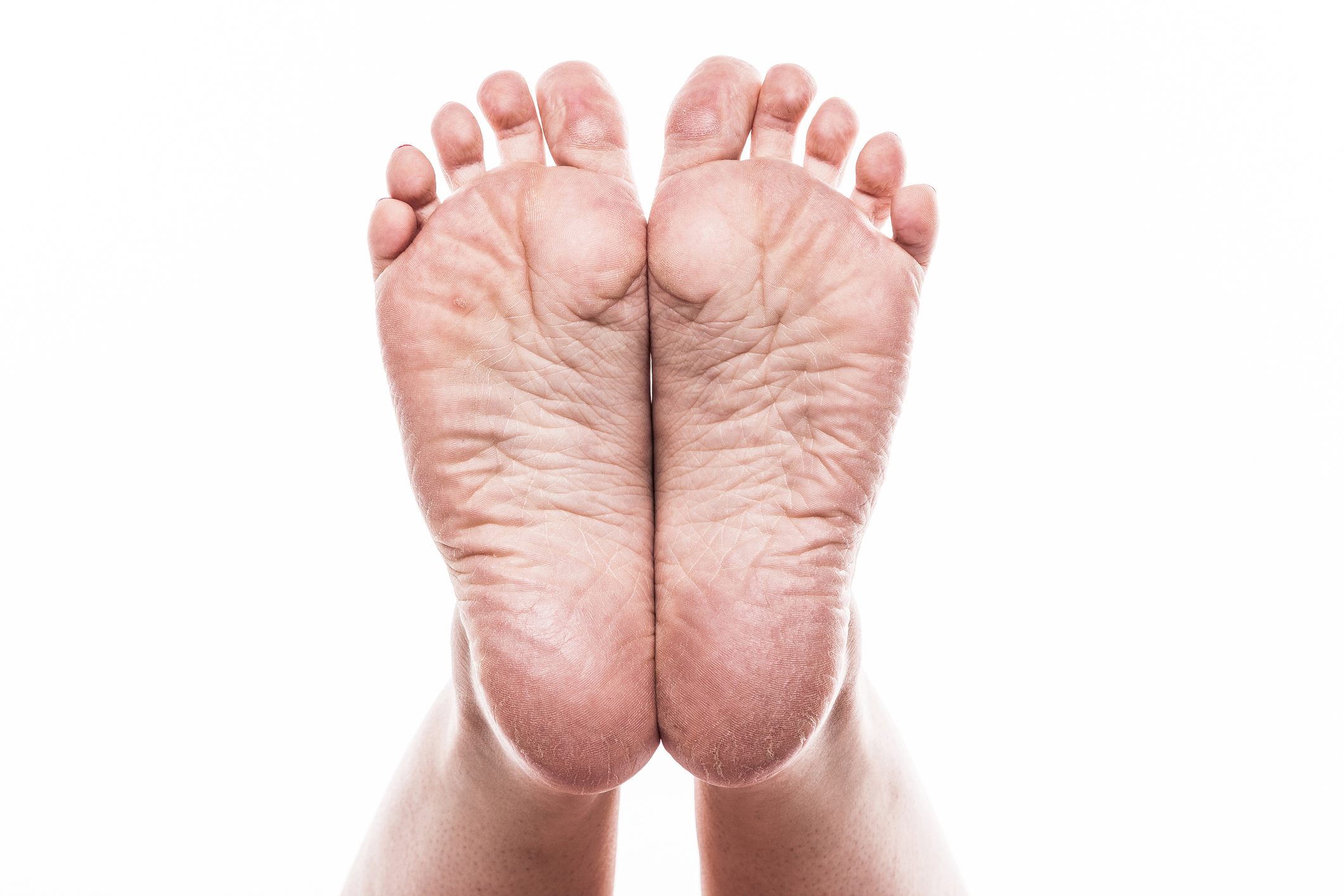 foot with pedicure and poor over-dry skin on the heels