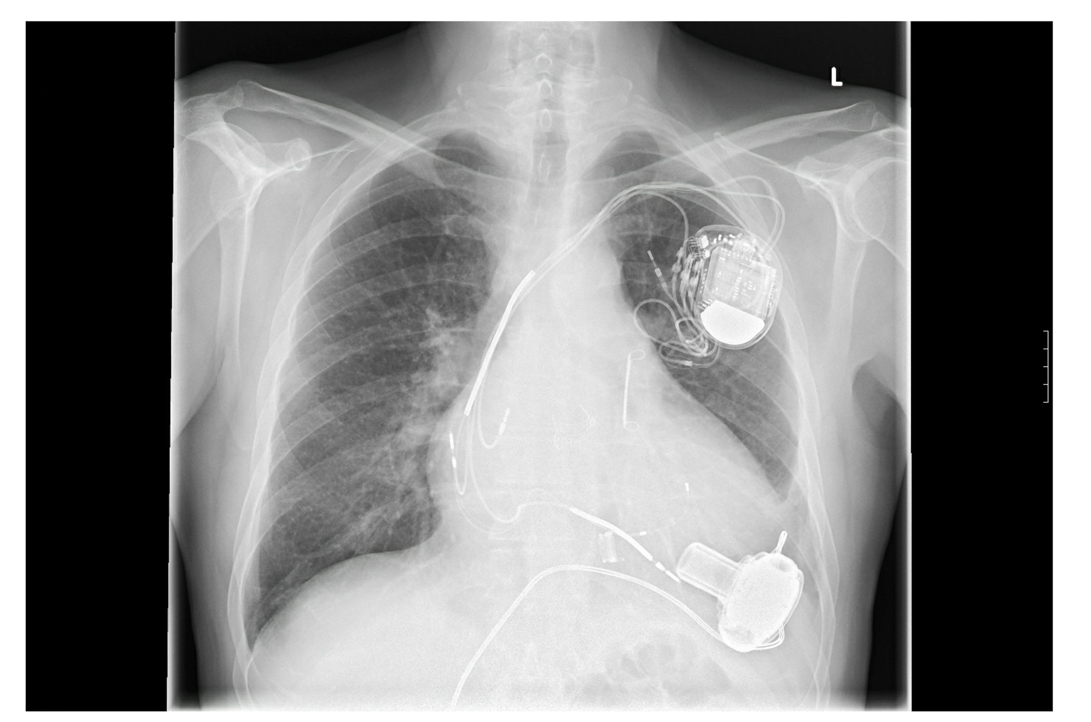 Xray of heart pump and pacemaker