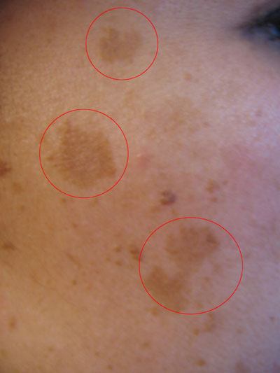 Melasma Circled