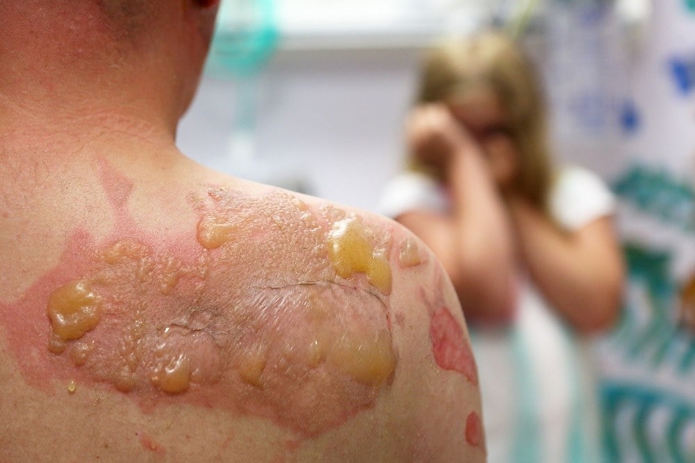 Back with second degree burn