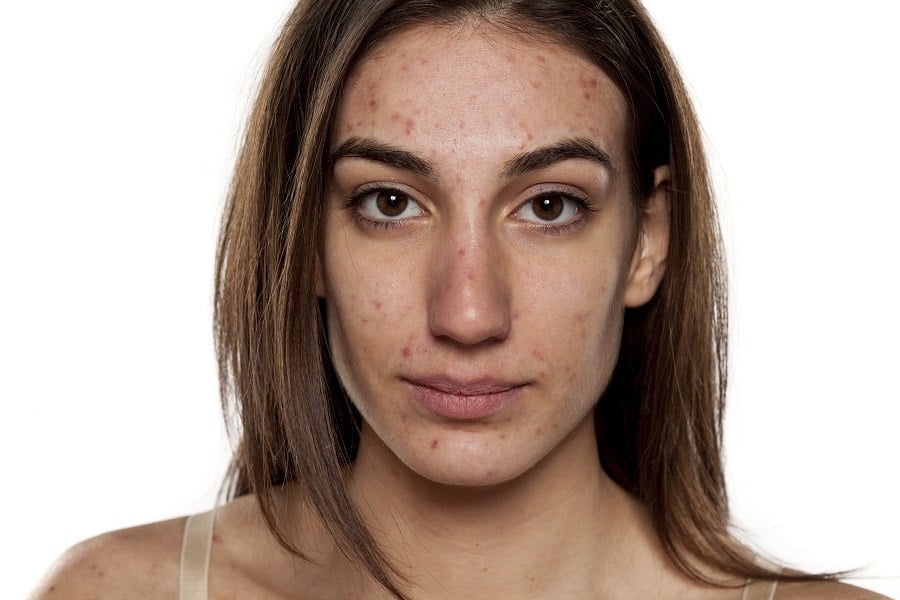 young women with problematic skin