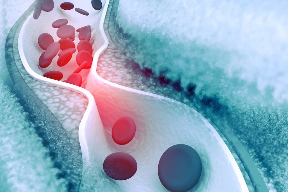 Cholesterol plaque in artery