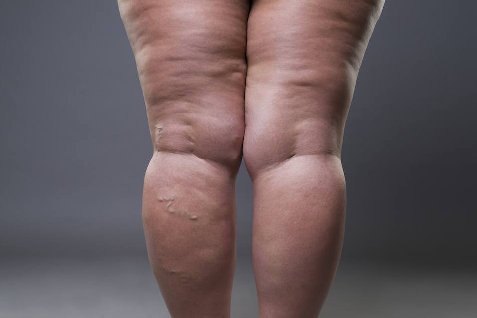 Female legs with cellulite and varicose veins Female legs with cellulite and varicose veins