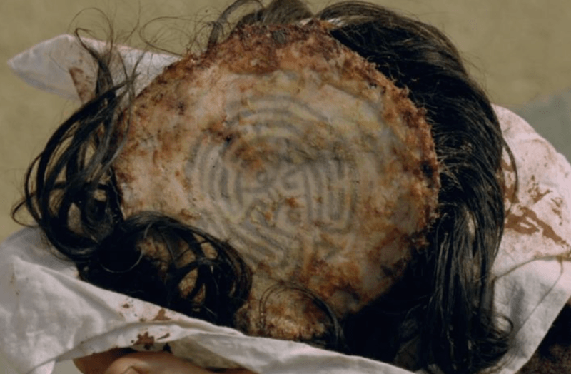 Maze on scalp of head. Maze on scalp of head.