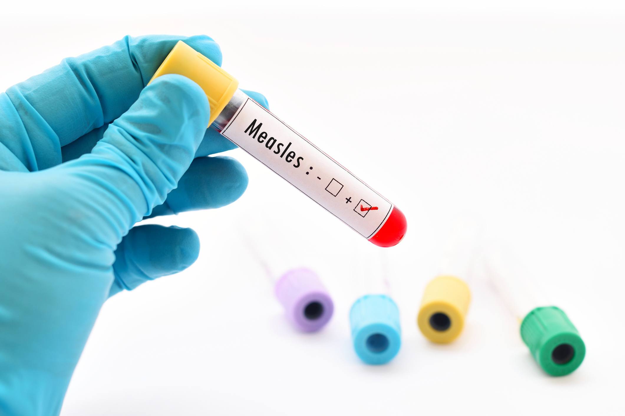 Measles sample