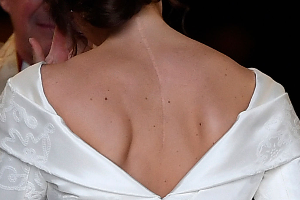Princess Eugenie's scar