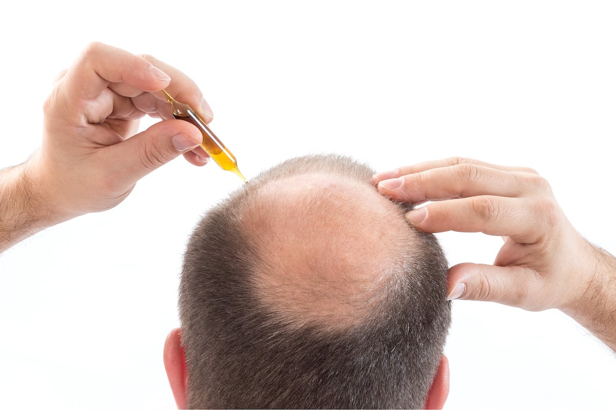 Man applying hair loss treatment to bald spot