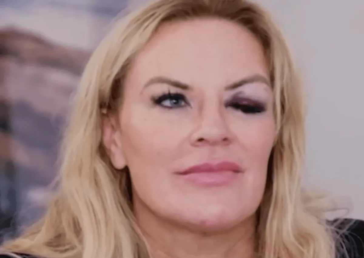 Heather Gay has a black eye.
